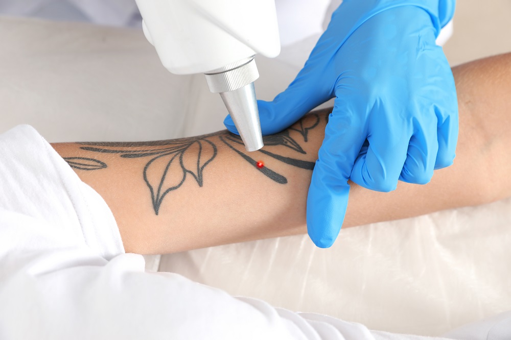 eliminación de tatuajes en asturias
